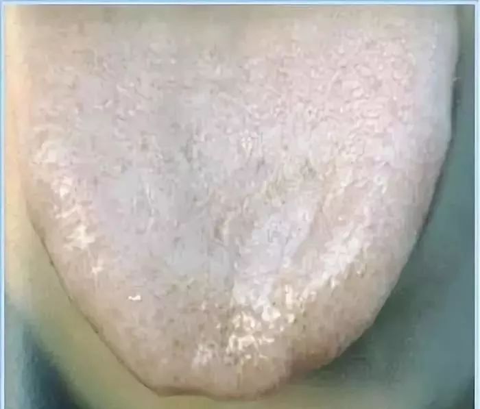 宝宝舌苔怎么辨别热还是寒,如何看宝宝舌苔来区别是否感冒