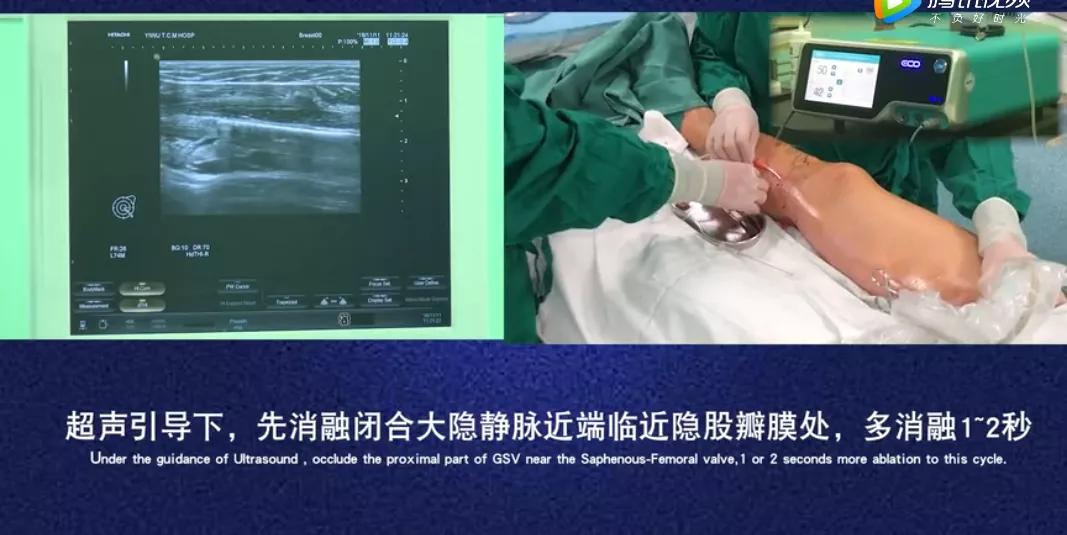 下肢静脉曲张治疗目的,精索静脉曲张吃药能治愈吗