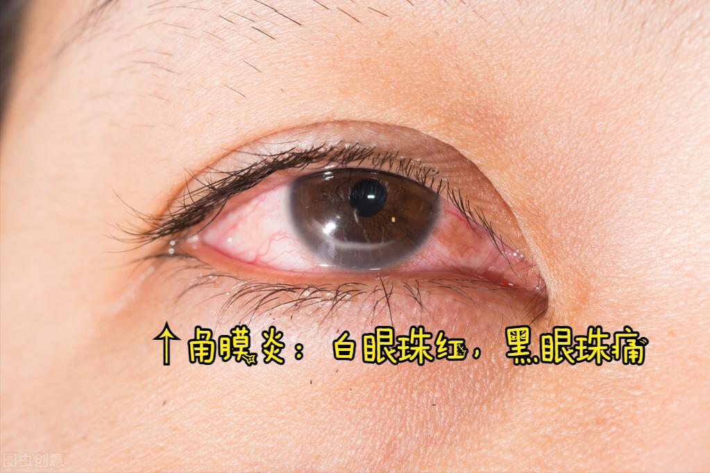 眼科角膜炎怎么治疗,角膜炎属于眼底病吗