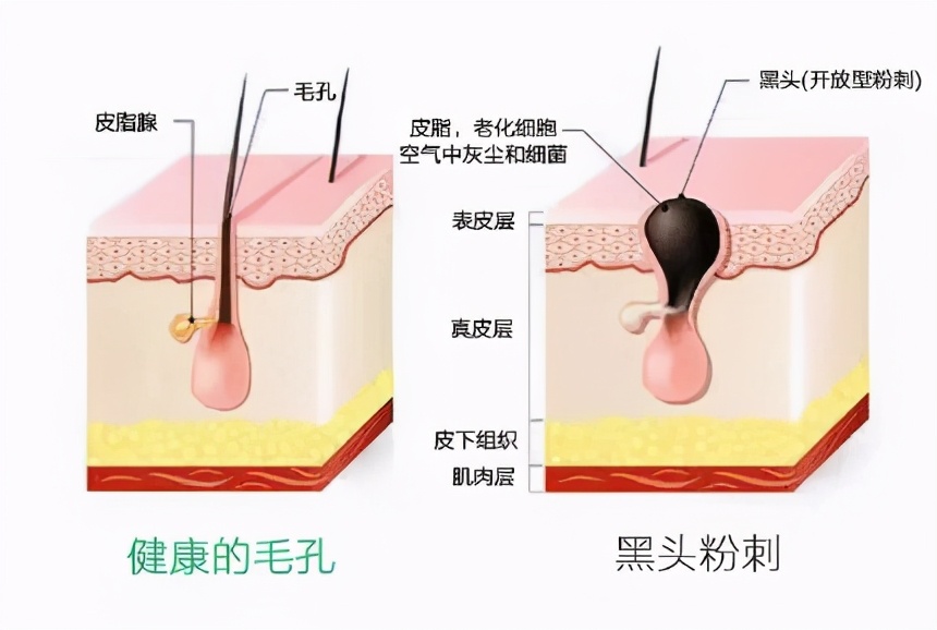 去黑头的药膏国货之光,国货祛黑头药膏排行榜