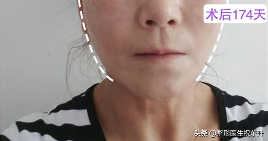 法令纹严重怎么办30岁,中年人怎么去除法令纹