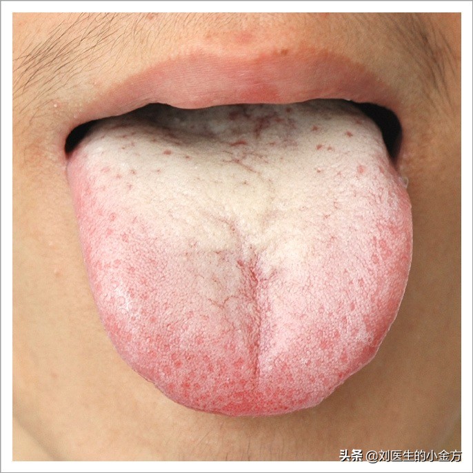 中医舌诊图解100例,中医舌诊图与舌诊口诀