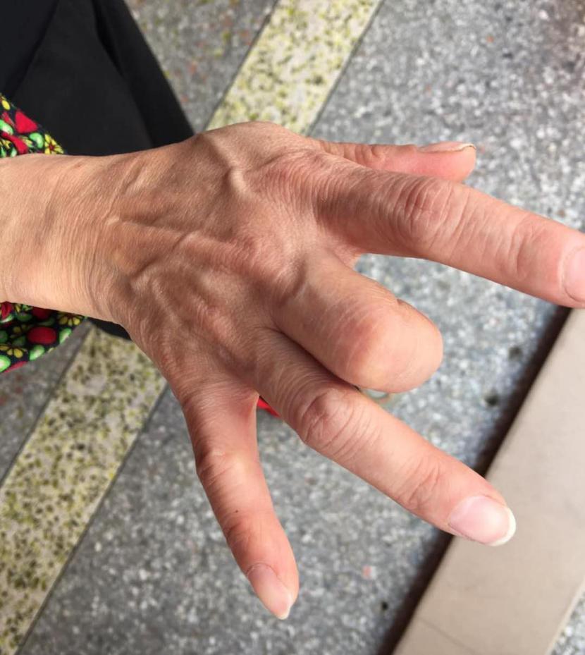 医生,我的手指为什么伸不直了