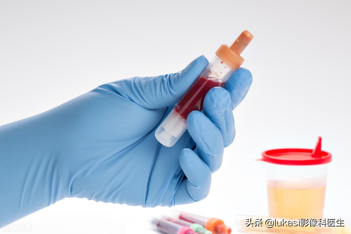 癌症患者尿血意味着什么,便血尿血是不是意味着得了癌症