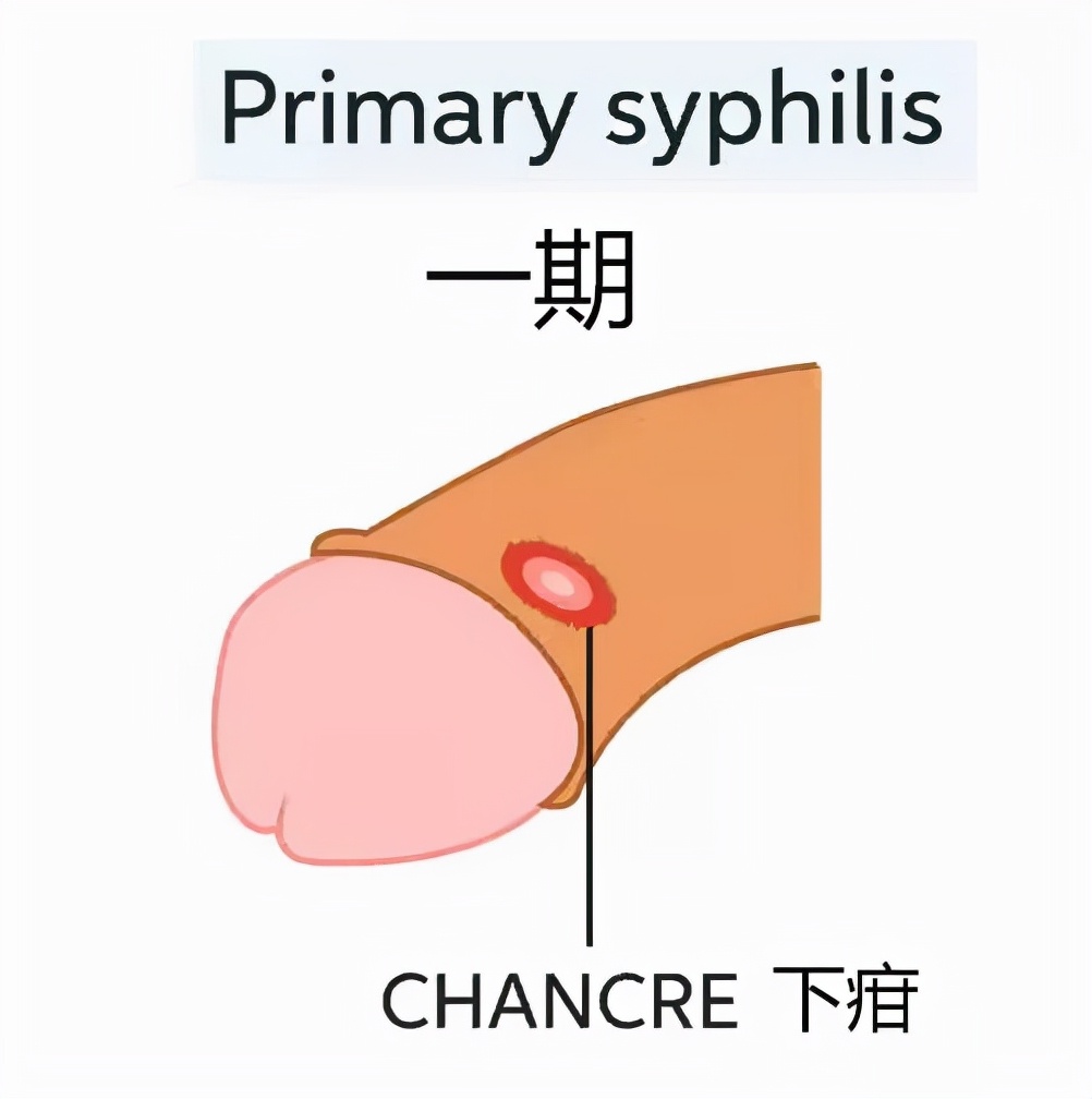 婚后查出梅毒婚姻有效吗,结婚后发现对方隐瞒患过梅毒