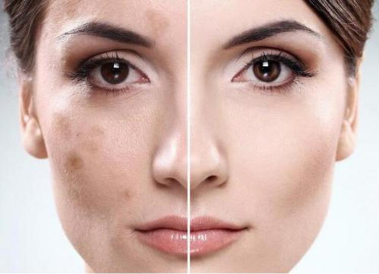 皮肤长斑长痘毛孔粗大的原因,皮肤毛孔粗大什么原因造成的