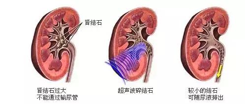 碎石完没有石头了腰还是疼,碎石后没感觉有石头排出来