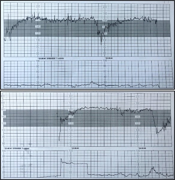 新冠母婴传播,新冠婴儿容易感染吗