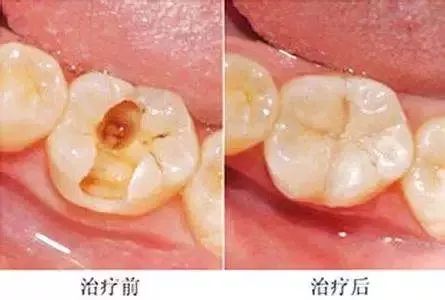 牙蛀了要补吗,牙齿蛀了一点需要补牙吗