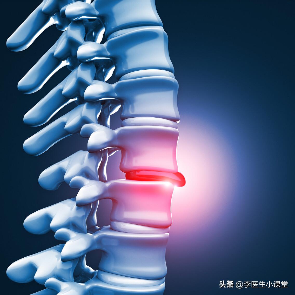 腰间盘突出的康复治疗,腰间盘突出的康复治疗有哪些