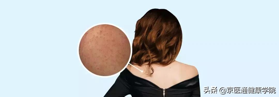 顽固湿疹痘痘,痘痘湿疹肌肤怎么改善