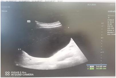 肝囊肿超声引导下硬化治疗泉州,王府医院肝科