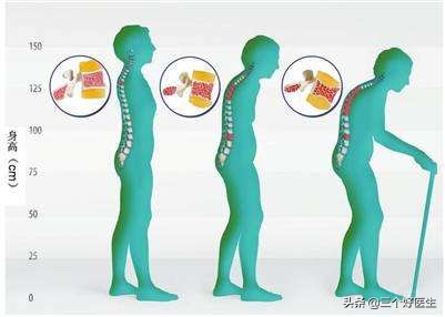 国外压缩性骨折治疗方案,压缩性骨折自愈技巧图片