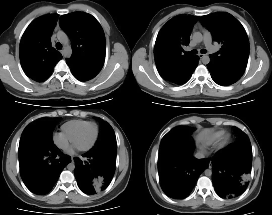 青年男性肺炎过后一直咳嗽怎么办,潜伏结核感染咳嗽咳痰