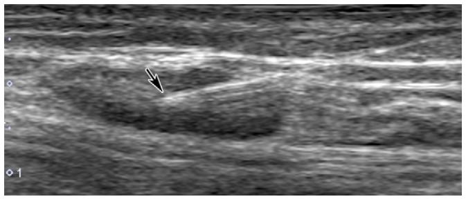 盆腔囊性淋巴管瘤可以治愈吗,盆腔淋巴管囊肿