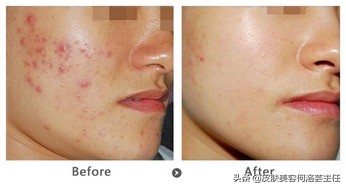 战痘神器效果怎么样,治痘神器国货