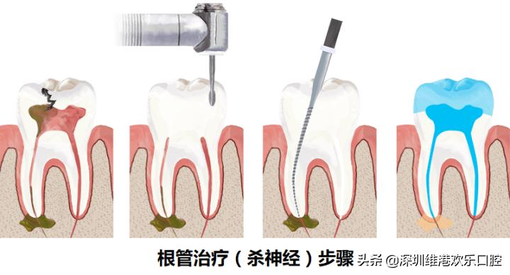 牙齿小洞你不瞅，变成大洞愁上愁