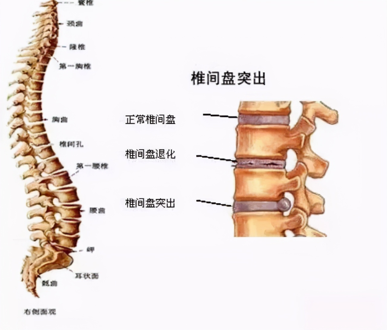 腰突引起的腿疼屁股疼怎么治疗,百年扁氏老黑膏治疗腰突有效吗