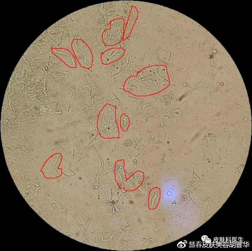 是湿疹或癣医生一眼就能辨出来吗,是不是体癣怎么检查