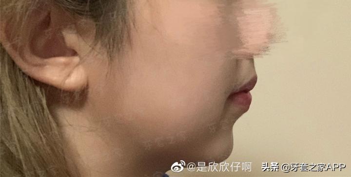 不靠整容怎么改变下巴后缩?看这里