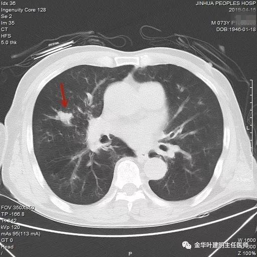 能不能手术,极重度混合性通气功能障碍能治吗
