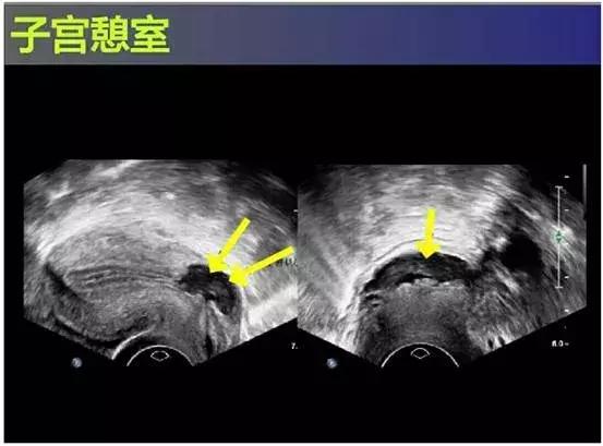 子宫憩室手术后怎么调理身体,子宫憩室手术后还会有憩室吗
