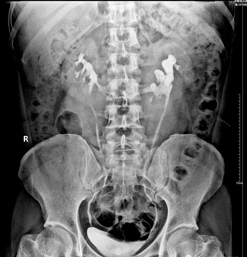 祸不单行因祸得福案例,祸不单行因祸得福的视频