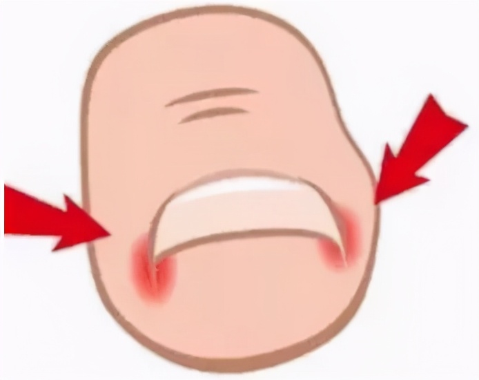 拔甲可以彻底治好嵌甲性甲沟炎吗,嵌甲甲沟炎拔了指甲还是红肿有脓