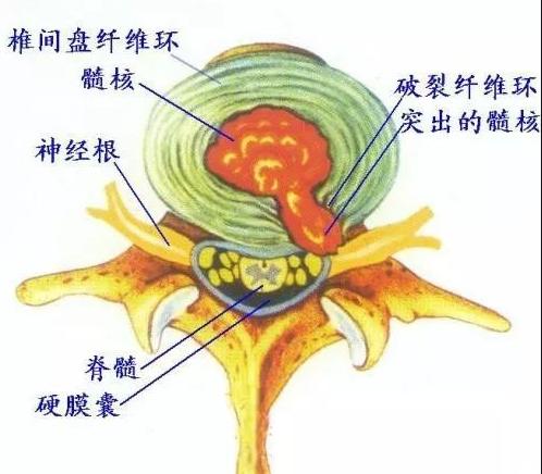 腰椎间盘突出躺在床上腿还疼,腰椎间盘突出了为什么腿会疼