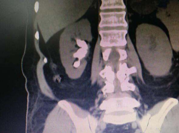 肾结石无创手术靠谱吗,无创治疗肾结石全过程