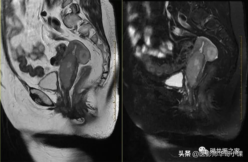 「精品课件」带大家看看，磁共振子宫MRI要如何扫描？