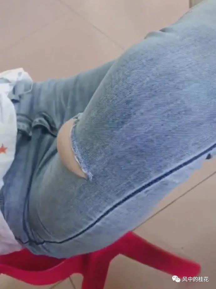 溜冰摔了膝盖关节处肿了,溜冰摔倒了膝盖不能弯曲