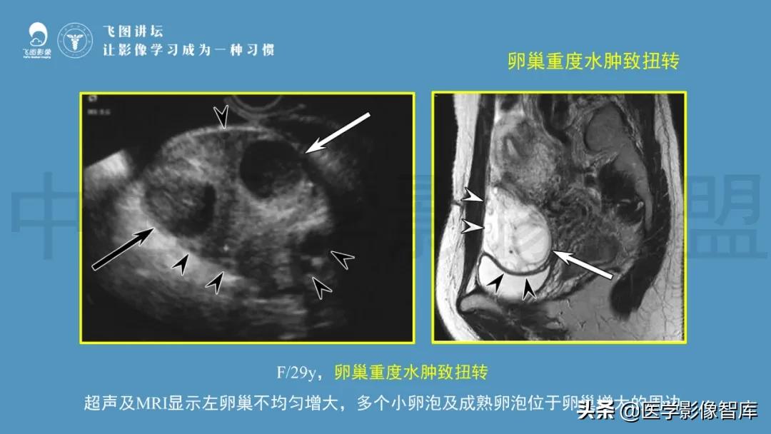 子宫解剖结构输卵管和卵巢位置,子宫附件ct影像学正常解剖表现