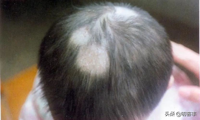 孩子得了头癣怎么办,孩子头癣