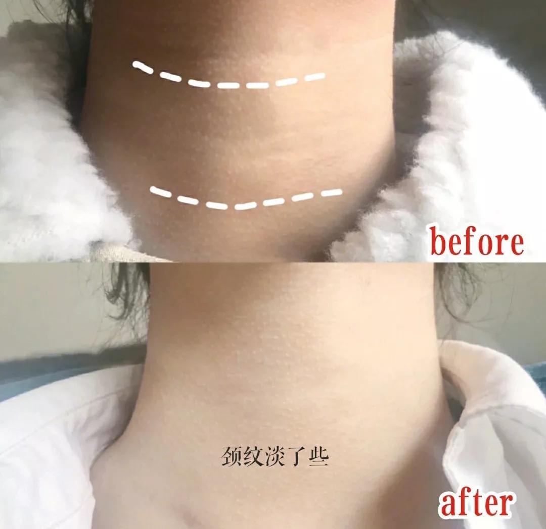 有颈纹和没有颈纹的女人,女人有颈纹怎么办