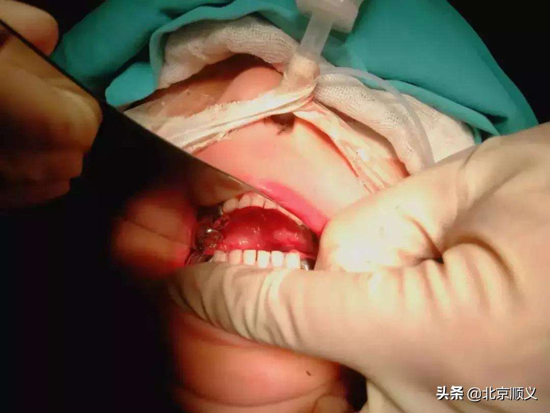 顺义儿童牙科治疗医院,顺义儿童补牙