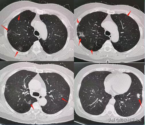 肺癌基因突变会遗传后代,基因突变的肺癌遗传吗