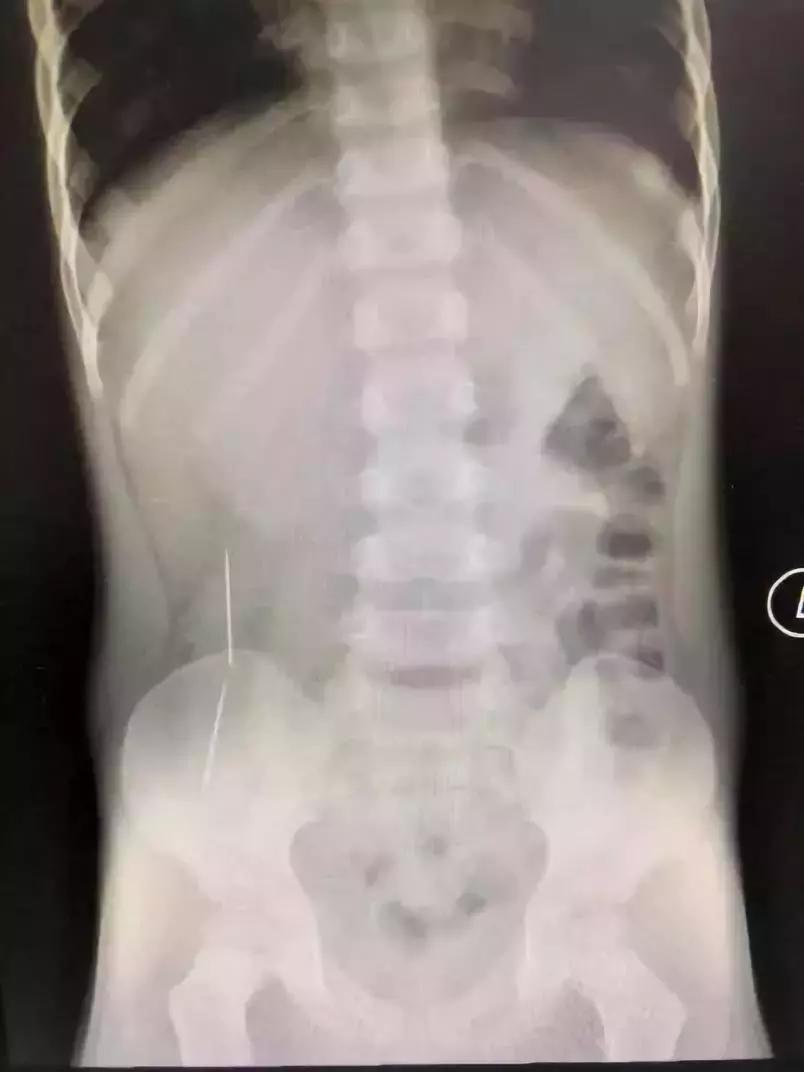 儿童误吞玻璃死亡,孩子误吞了碎玻璃怎么办