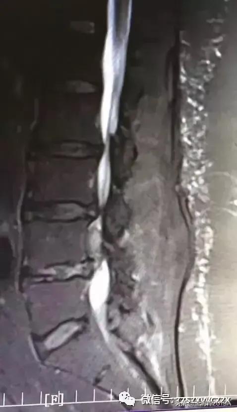 弯腰捡东西,腰痛腿麻大小便*禁失**,竞是腰椎间盘髓核脱出惹的祸