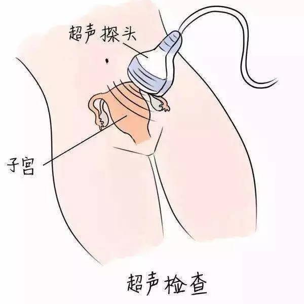阴超和妇科超声,腹超阴超