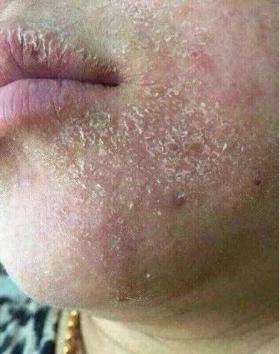 春敏后期全脸脱皮,过敏脸上起皮发痒