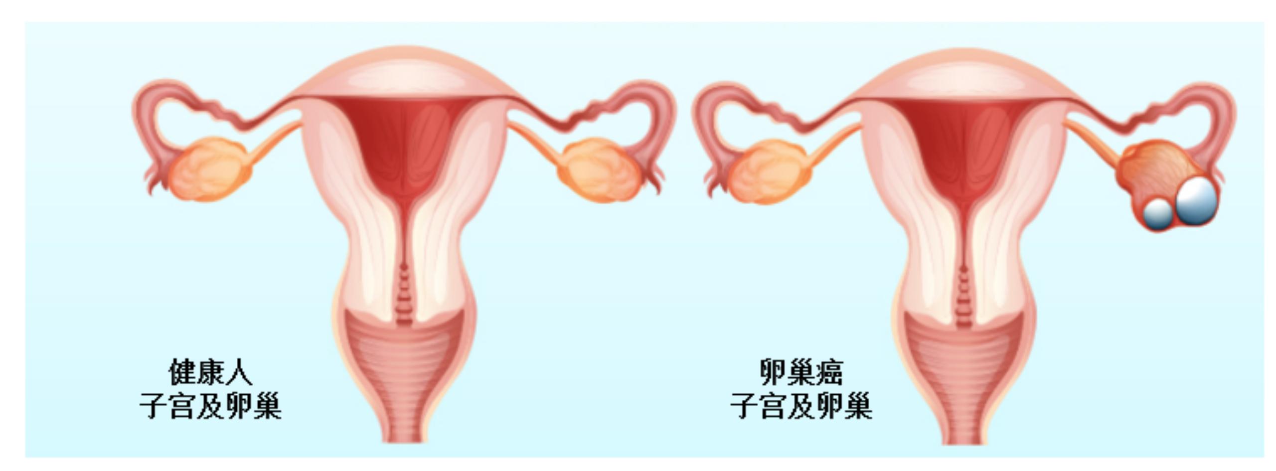 卵巢癌基因检测与靶向治疗与化疗,卵巢癌基因检测靶点