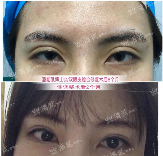 双眼皮改单眼皮案例,扇形双眼皮改平行双眼皮多少钱