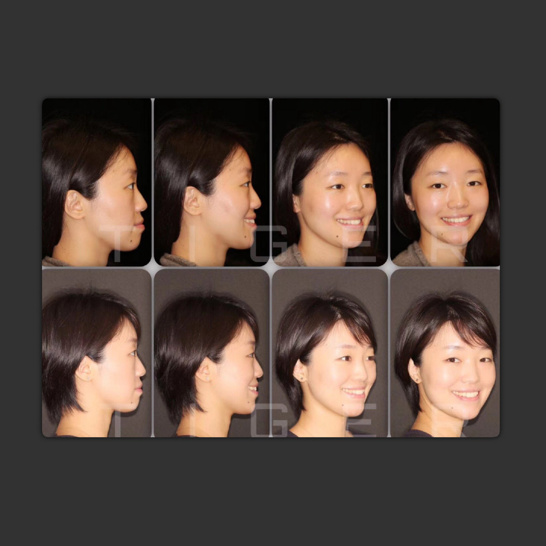 南京隐适美认证医师,南京隐适美价格