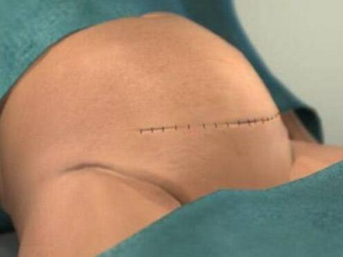 疤痕体质孕妇要注意什么,疤痕体质孕妇剖腹产后疤痕什么样