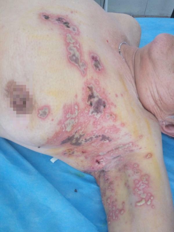 有没有最好的方法治疗带状疱疹,单纯疱疹与带状疱疹哪个难治