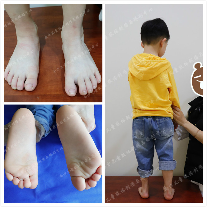 严重马蹄内翻足新生儿,先天性马蹄内翻足成年后能治疗吗