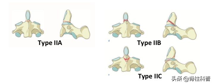逃过了医院手术的一劫,halovest支架