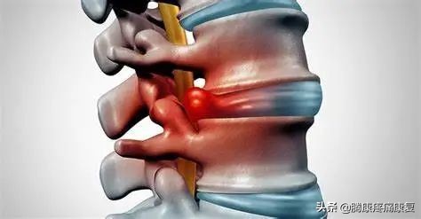 腰椎间盘退行性改变怎么治疗呢,腰椎间盘退行性改变是什么意思