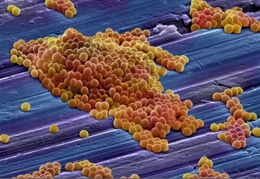 食肉菌感染有多可怕,食肉菌是不是罕见病菌